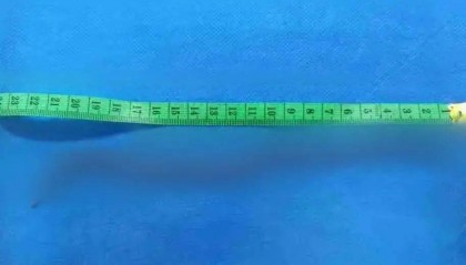 女子体内取出20厘米活虫！只因频繁吃一道美食……