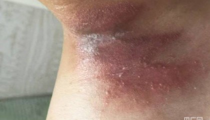 河南多地出现隐翅虫 医生提醒：保持室内清洁 发现切勿拍打