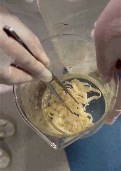 女子体内排出10米长绦虫!原是两年前旅游时吃了这种食物