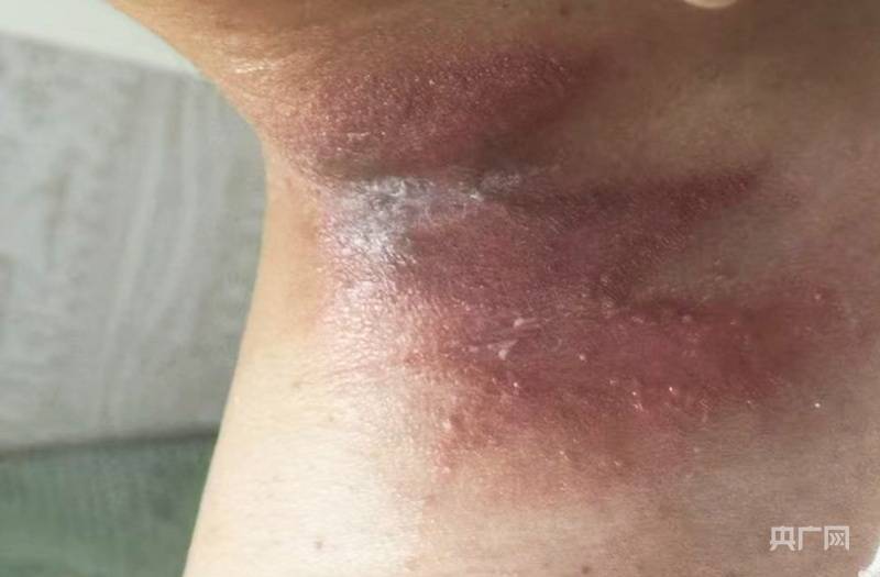 河南多地出现隐翅虫 医生提醒:保持室内清洁 发现切勿拍打